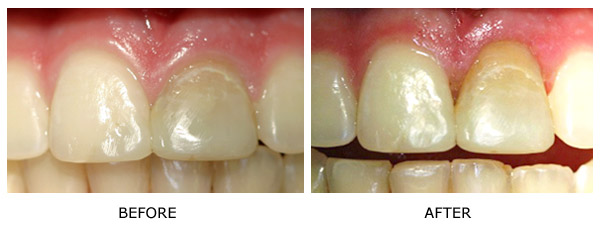 Gingival Asymmetry