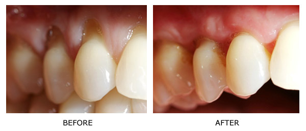 AlloDerm Graft