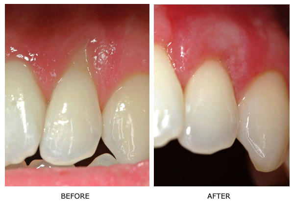 Gingival Cleft